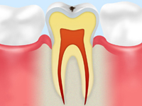 treatment_caries_03