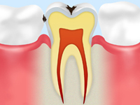 treatment_caries_04
