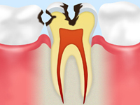 treatment_caries_05