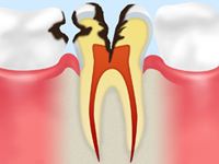 treatment_caries_06