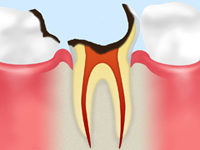 treatment_caries_07