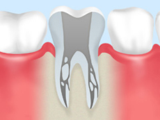 treatment_caries_08