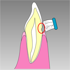 treatment_caries_09