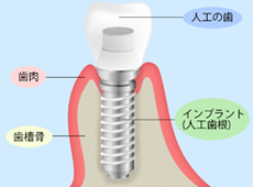 treatment_implant_02