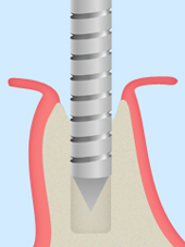 treatment_implant_04