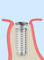 treatment_implant_05