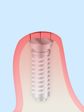 treatment_implant_06