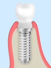 treatment_implant_08