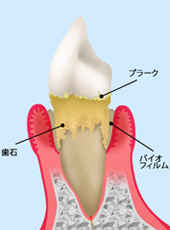 treatment_perio_01