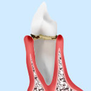 treatment_perio_03