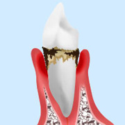 treatment_perio_04