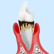 treatment_perio_05