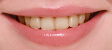 treatment_whitening_01
