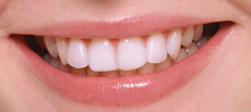 treatment_whitening_02