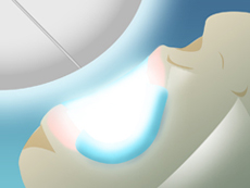 treatment_whitening_04