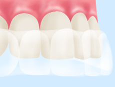 treatment_whitening_05
